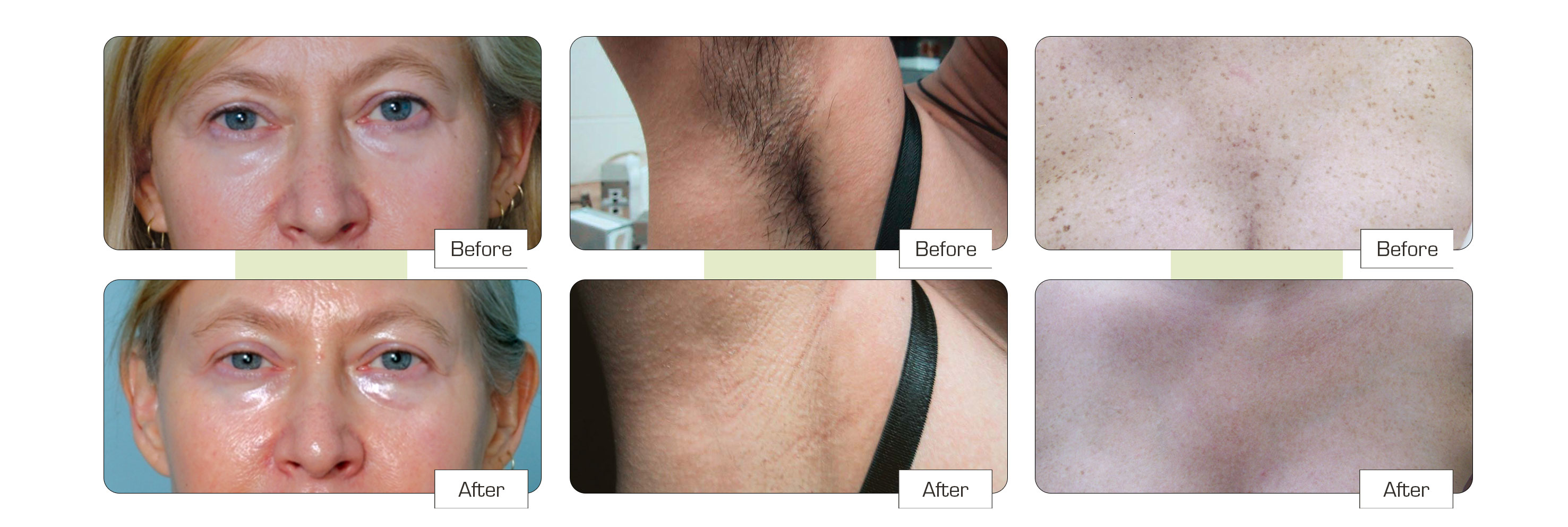 Laser hair removal Colchester before and after images